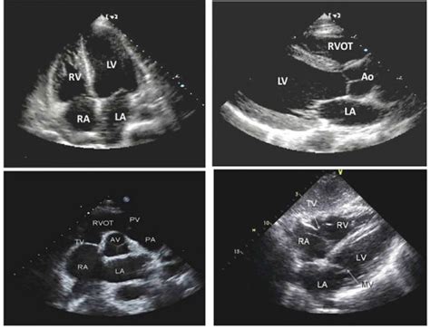 Echocardiographic Assessment Of The Right Ventricle From The