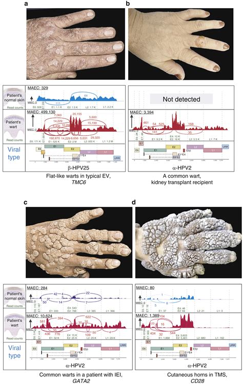 Recalcitrant Warts Epidermodysplasia Verruciformis And The Tree Man