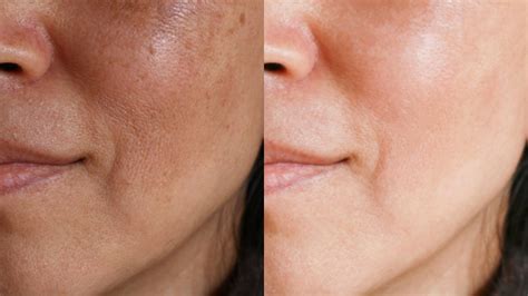 How To Treat Uneven Skin Tone And Get Clear Skin Life Style And More