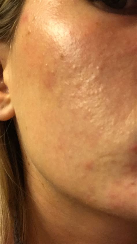 How To Get Rid Of These Bumps All Over Face General Acne Discussion
