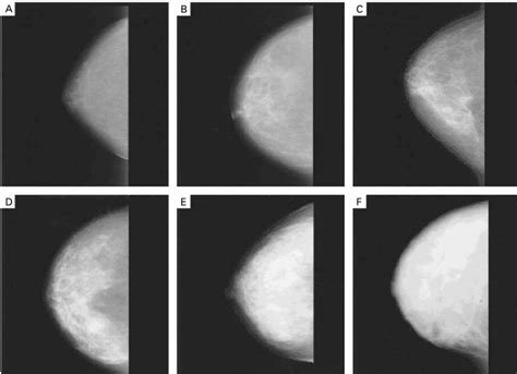 Examples Of Mammographic Density The Mammograms Show Breasts With 0