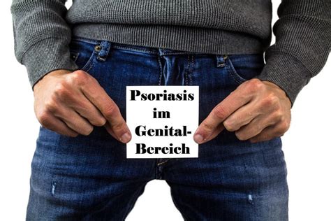 Psoriasis Im Genital Bereich Farbenhaut Alles über Schuppenflechte