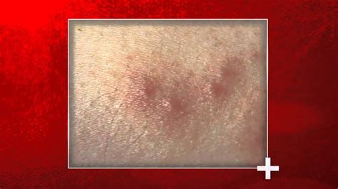 Signs Of Bed Bug Bites Health Checks Youtube