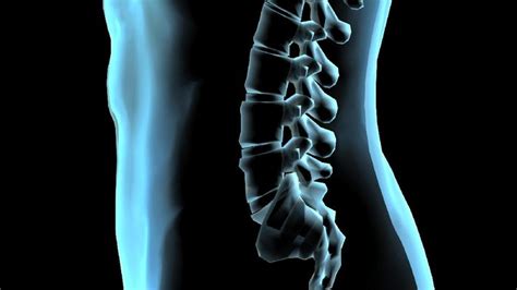 Hampir 4 dari 10 orang mengalami masalah tulang belakang bengkok. Fakta-fakta Mengejutkan Seputar Skoliosis, Tulang Bengkok ...