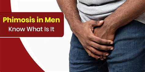 Phimosis In Men Know Symptoms Causes And Treatment Options Onlymyhealth
