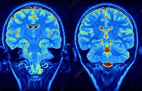 Normal Brain Mri Scan Stock Image C0030929 Science Photo Library
