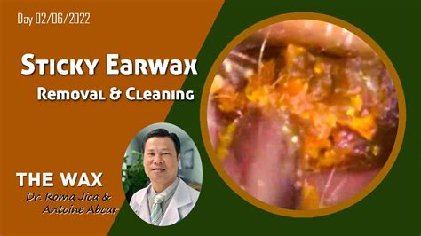 Fully Sticky Ear Wax Removal And Cleaning Youtube