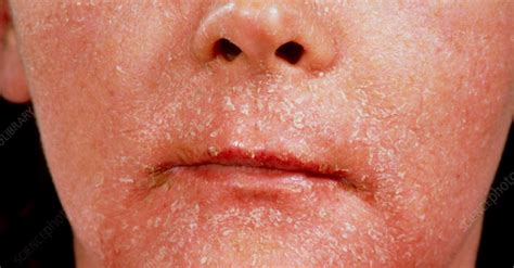Persistent Facial Erythema Red Face Dermatology Games