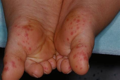Hand Mund Fuß Krankheit Symptome Bilder And Behandlung