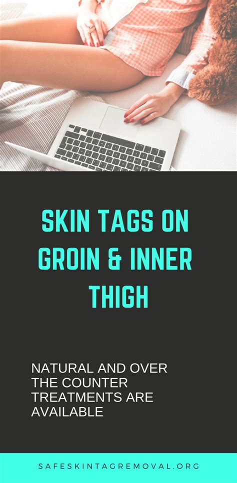 Eliminate Skin Tags On Groin And Inner Thigh Today Skin Tag Removal
