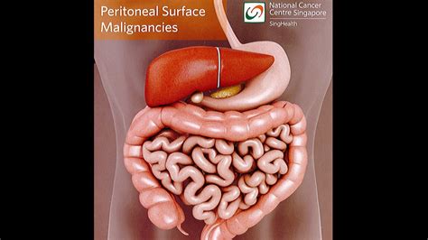 Peritoneal Cancer Peritoneal Tumours Youtube