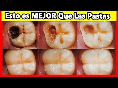 Ningún Dentista Quiere que Sepas de Este Remedio Porque Te Quita Las