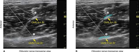 Ultrasound Guided Obturator Nerve Block Hadzics Peripheral Nerve