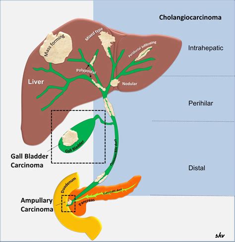 Maybe you would like to learn more about one of these? Imaging of malignancies of the biliary tract- an update ...