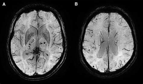 Cerebral Microbleeds Imaging And Clinical Significance Radiology