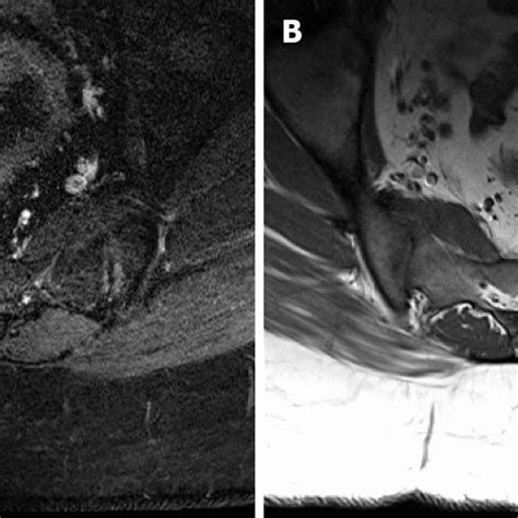 Axial T1 And Coronal Stir Images Demonstrate Mild Bilateral Sacroiliac