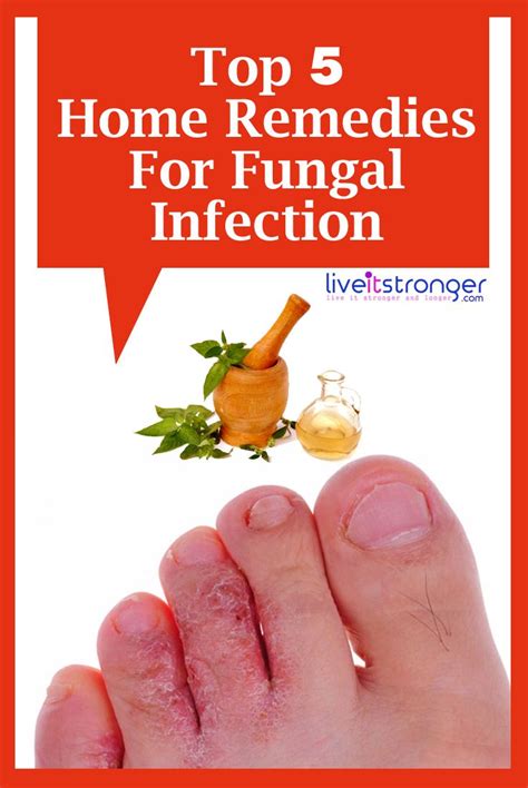 Top 5 Home Remedies For Fungal Infections Fungus Skin Tinea