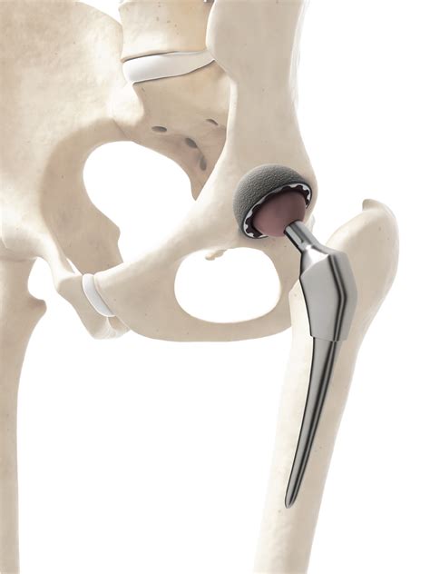 Joint Replacement Tallahassee Orthopedic Clinic