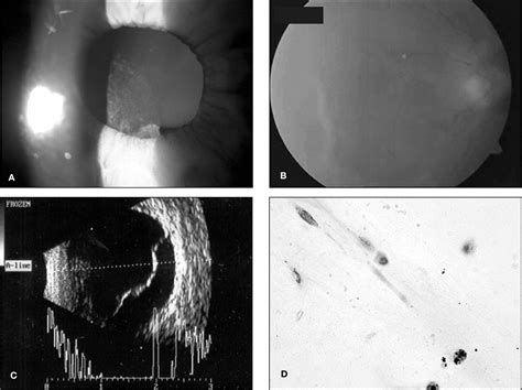 Figure 3 From The Role Of Pars Plana Vitrectomy In The Diagnosis And