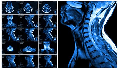 Do Patients With Neck Injuries Really Need That Mri After A Normal Ct