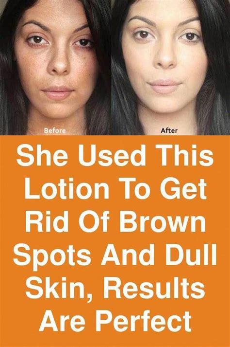 How To Get Rid Of Brown Spots On Face Whitedeerwithbrownspots