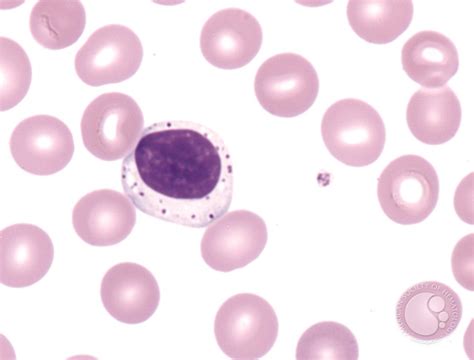 Large Granular Lymphocyte Leukemia 2