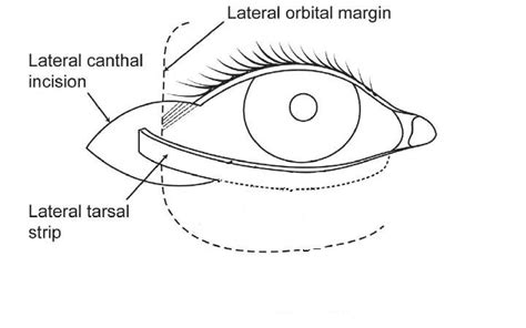 Lateral Tarsal Strip Technique For Correction Of Lower Eyelid Ectropion