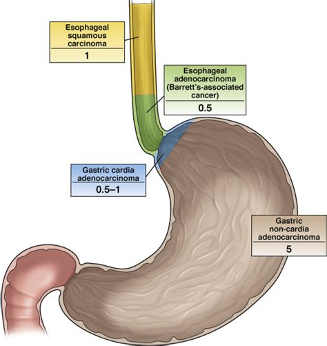 The Clinical Evidence Linking Helicobacter Pylori To Gastric Cancer
