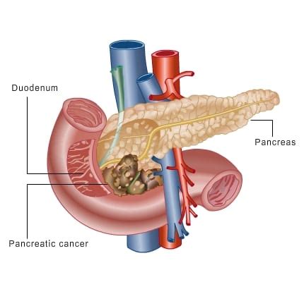 Most pancreatic cancers are exocrine cancers. Pancreatic Cancer