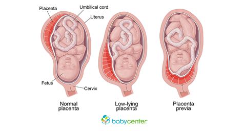 Placenta Previa Symptoms Possible Complications And Risk Factors Babycenter