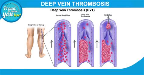 How To Deal With Deep Vein Thrombosis Dvt Deep Vein T