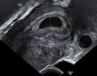 Der dottersack ist die nahrungsquelle des embryos in den frühen stadien vor der entwicklung der zirkulation. Abbildungen und Graphiken: Tipps und Tricks im Gyn ...