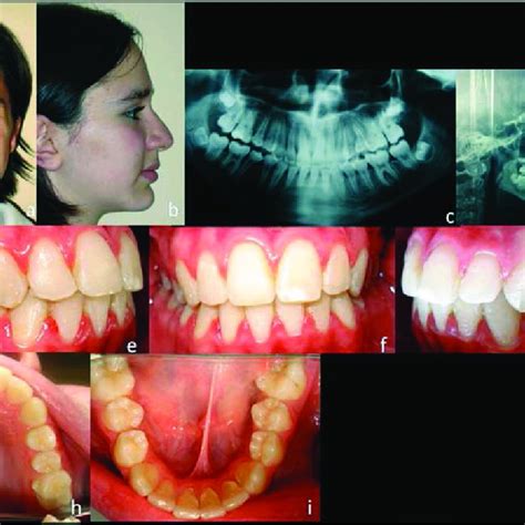 Pdf Orthodontic Treatment Of Transposition Of Permanent Mandibular