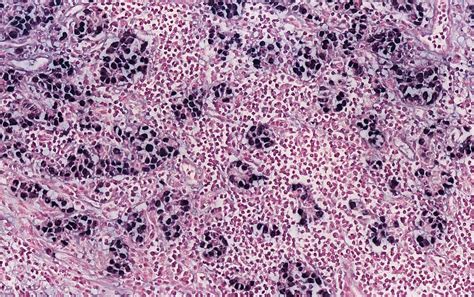 Pathology Outlines Gastric Carcinoma With Lymphoid Stroma