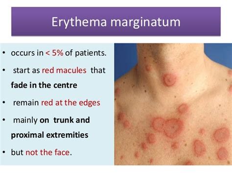 Erythema As Related To Licorice Pictures