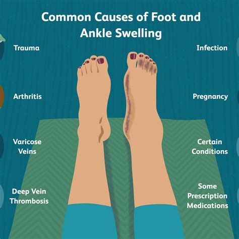 How To Keep Ankles From Swelling Aimsnow