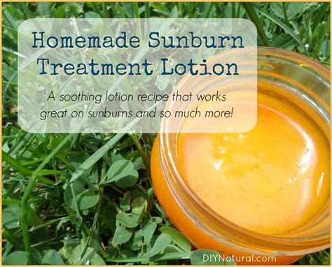 Home Remedies For Sunburn A Diy Sunburn Treatment Lotion