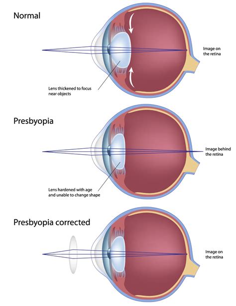 Learn More About Presbyopia Nikon Lenswear Us