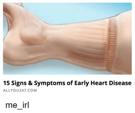 Heart Disease Edema Legs Cardiovascular Disease
