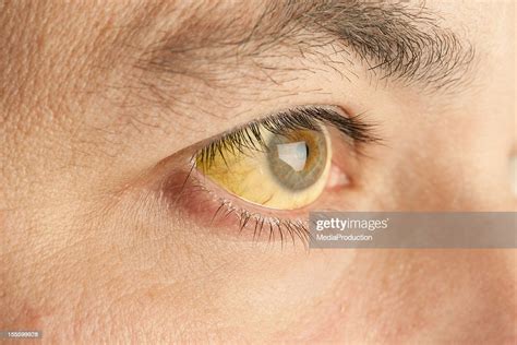 Jaundice High Res Stock Photo Getty Images