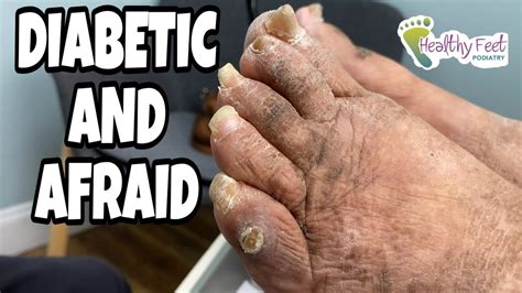 Really Bad Feet With Neglected Nails Corns And Toejam Youtube