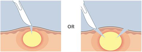 Derma Stent Abscess Drain Minimally Invasive Abscess Drain