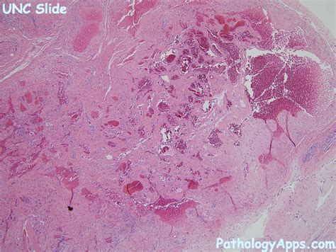 Venous Hemangioma Soft Tissue Histology