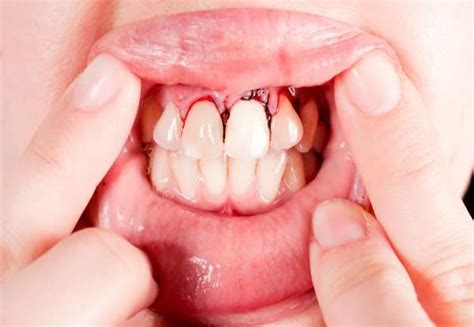 For Bleeding Gum Greenlife Dental