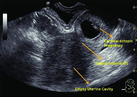 Early Cervical Ectopic Pregnancy With Embryonic Pole Transvaginal Hot Sex Picture