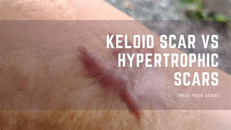 Keloid Scar Vs Hypertrophic Scar Treat Your Scars