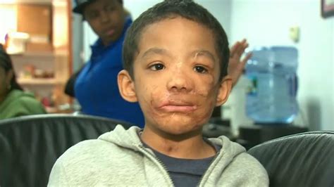 Young Staten Island Boy Attacked By Pit Bull Surprised With Trip To