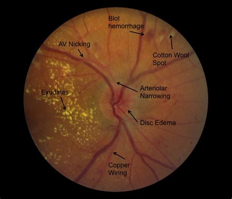 Moran Core Hypertensive Retinopathy