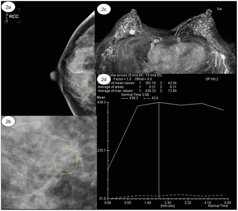 Ab Right Craniocaudal View Mammogram Of Punctate Microcalcifications