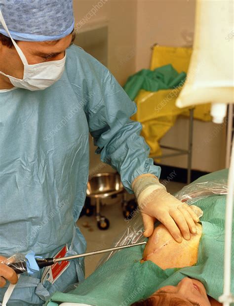 Surgeon Conducts Liposuction For Breast Reduction Stock Image M590
